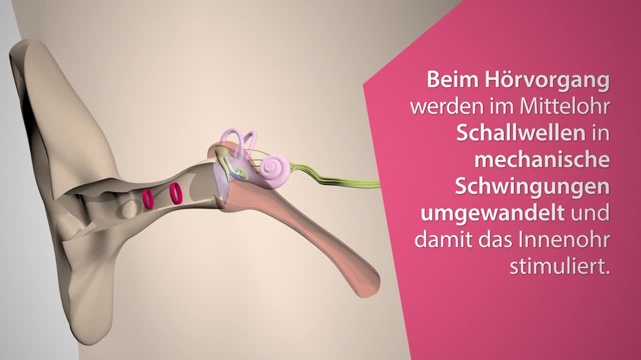 Mittelohrimplantat-System