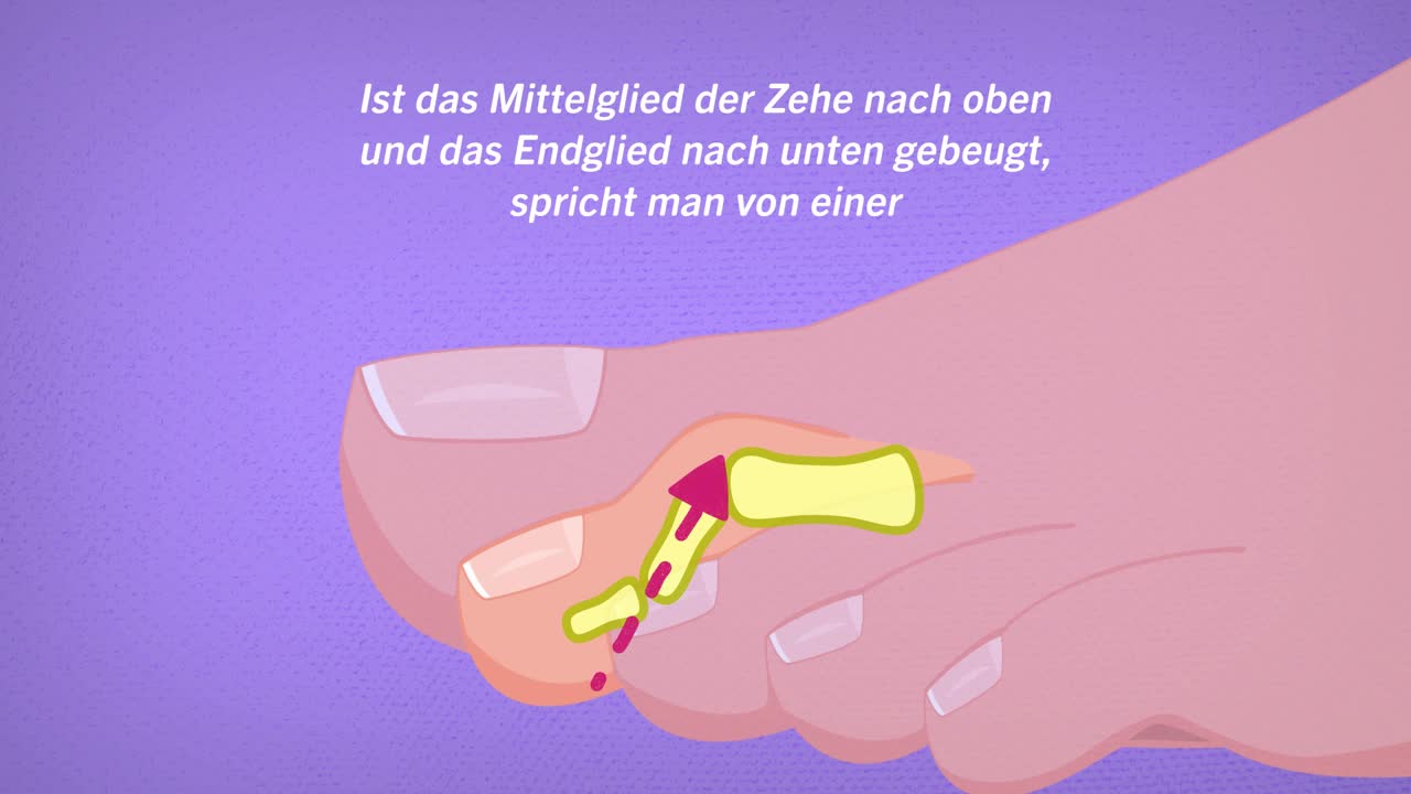 Minimalinvasive OP der Hammerzehe