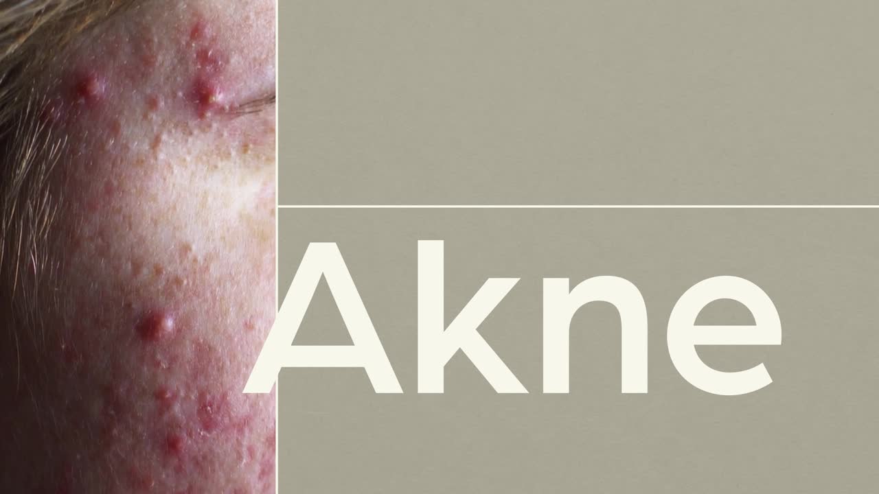 Akne und Aknebehandlung