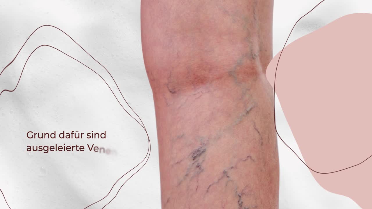 Schaumverödung (Besenreiser, Krampfadern)