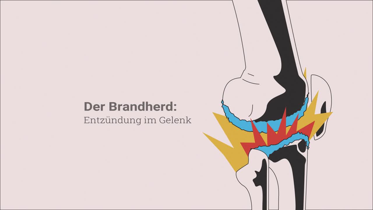 ACS / Autolog-konditioniertes Serum